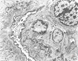 type I membranoproliferative glomerulonephritis